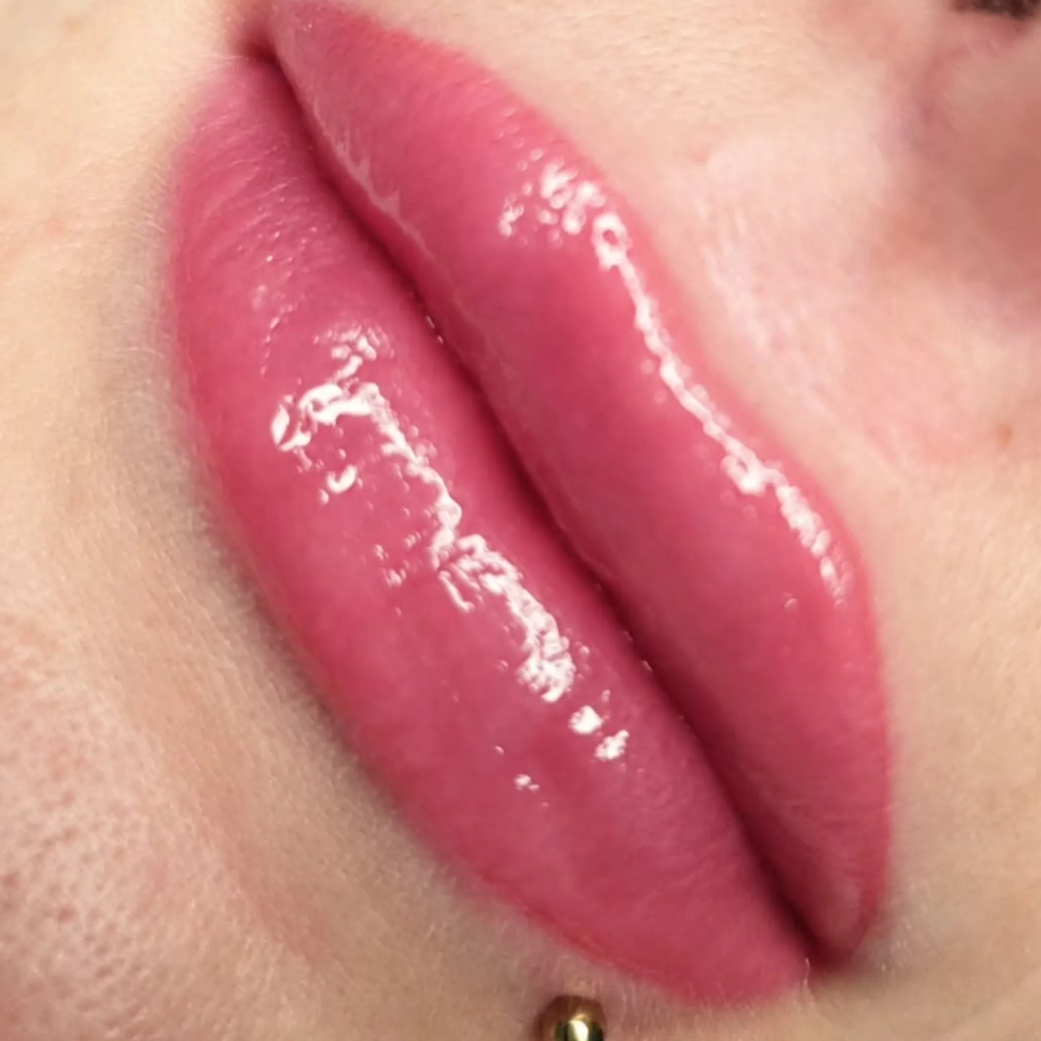 freshly treated lips during healing